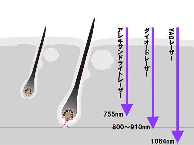 使用しているレーザー脱毛機の効果