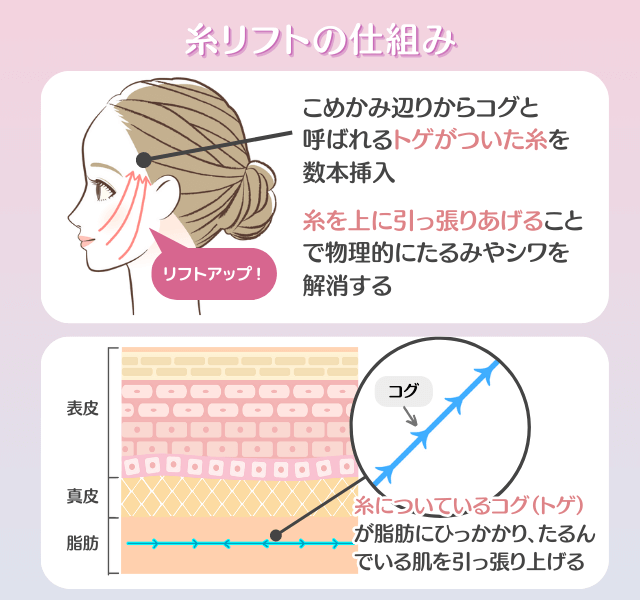 糸リフトってどんな施術？