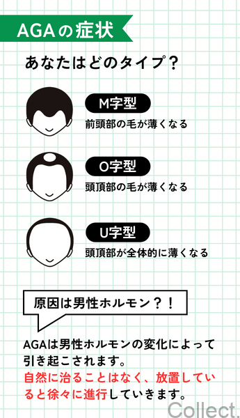 AGAとは？症状や原因を解説