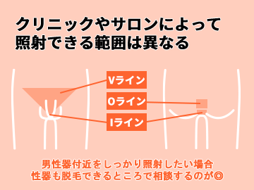 メンズVIO脱毛の照射範囲はどこまでか