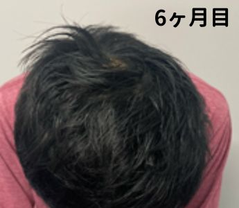 DMMオンラインクリニック治療6ヶ月