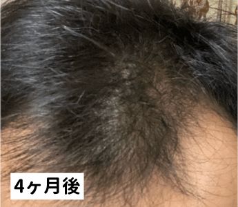 DMMオンラインクリニック治療2ヶ月