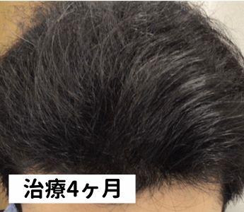 B&Hメディカルクリニック治療4ヶ月目