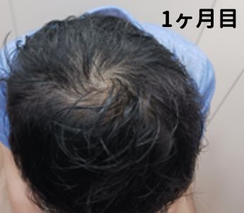 DMMオンラインクリニック1ヶ月目