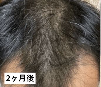 DMMオンラインクリニック治療4ヶ月