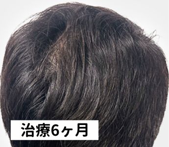 DMMオンラインクリニック治療6ヶ月