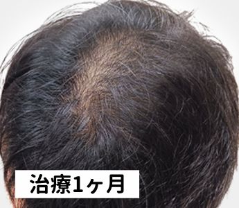 DMMオンラインクリニック1ヶ月目