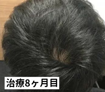 AGAヘアクリニック治療8ヶ月目