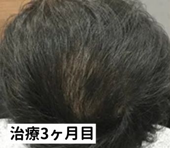 AGAヘアクリニック治療3ヶ月目