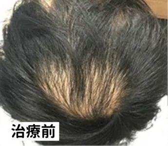 AGAヘアクリニック治療前