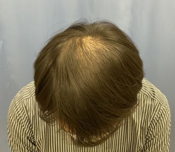 施術前