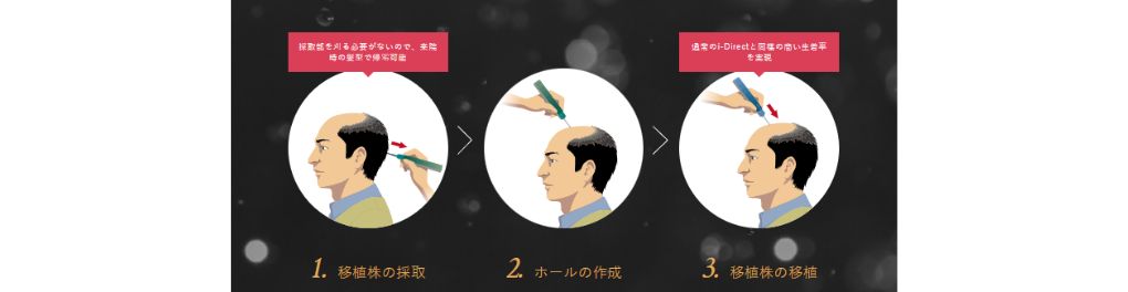 U-Direct（刈らないDirect）