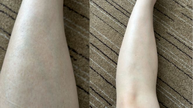 足脱毛(すね毛)2回目の肌