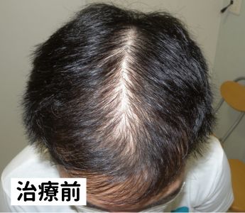 ウープス治療前