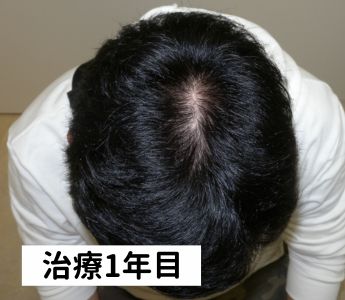 ウープス治療1年目