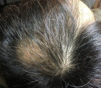 AGA治療開始前の頭皮状態