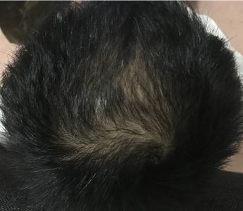 AGA治療開始から一年後の頭皮状態