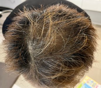 外用薬を一年間利用した頭皮状態