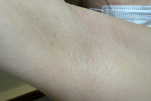蓄熱式脱毛を5回受けたワキ