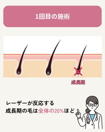 1回目の施術:全体の20%に効果