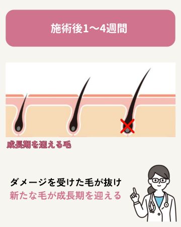 1〜4週間後:抜けて、また生える