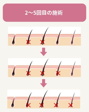 2回目〜5回目:照射を繰り返すことで、徐々に毛が減っていく
