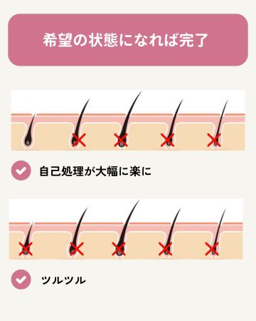 希望の状態になれば脱毛完了