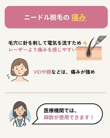 ニードル脱毛の痛み
