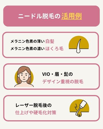 ニードル脱毛の活用例