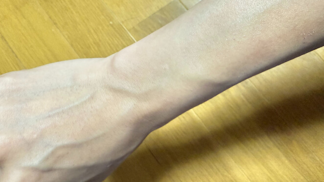 腕脱毛を4回受けた手の甲