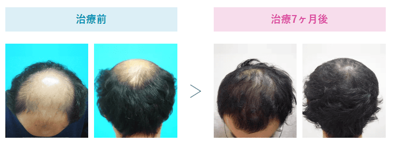 AGA治療効果-治療7カ月