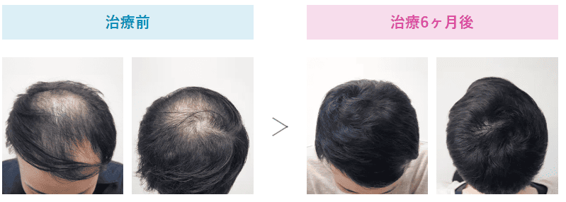 AGA治療効果-治療6カ月