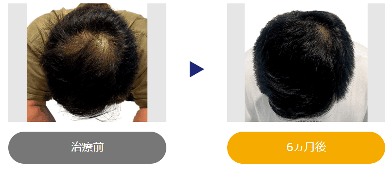 30代 6ヶ月治療の症例
