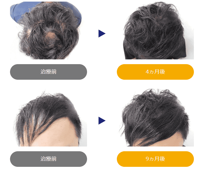 30代 9ヶ月治療の症例