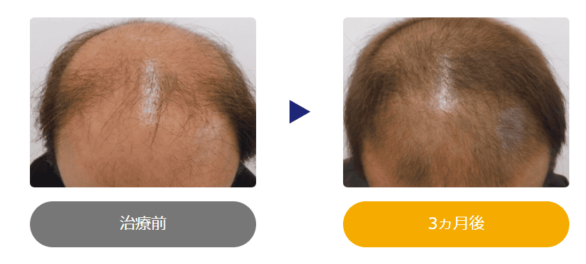 40代 3ヶ月治療の症例