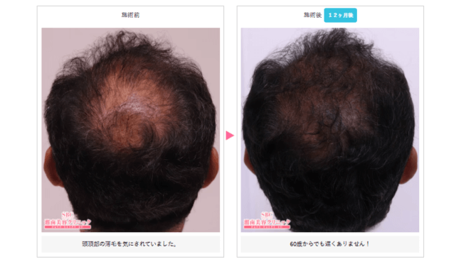 フィナステリドの症例写真