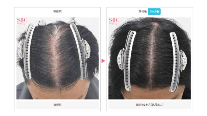 フィナステリド+ミノキシジルセットの症例写真