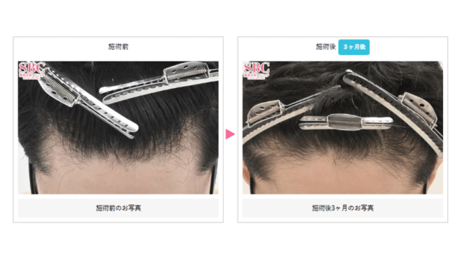 毛髪再生メソセラピーの症例写真