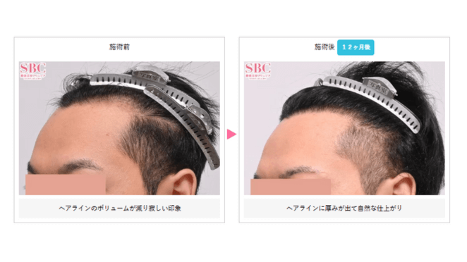 スマートFUE植毛の料金の症例写真