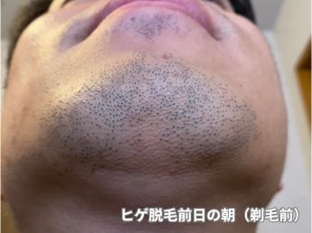ヒゲ脱毛前日（アゴ下）