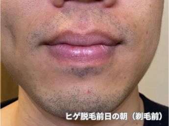 ヒゲ脱毛前日（鼻下・アゴ）