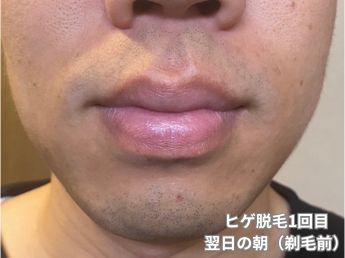 ヒゲ脱毛1回目の翌日の朝（鼻下・アゴ）