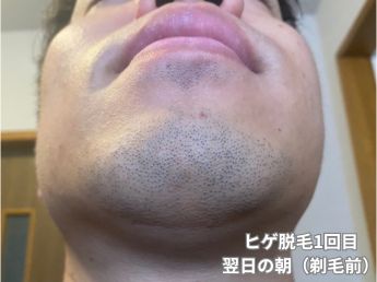 ヒゲ脱毛1回目の翌日の朝（アゴ下）