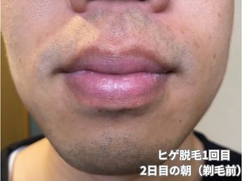 ヒゲ脱毛1回目の2日目の朝（鼻下・アゴ）