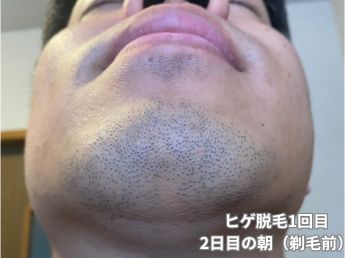 ヒゲ脱毛1回目の2日目の朝（アゴ下）