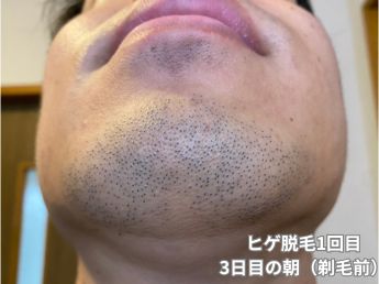 ヒゲ脱毛1回目の3日目の朝（アゴ下）