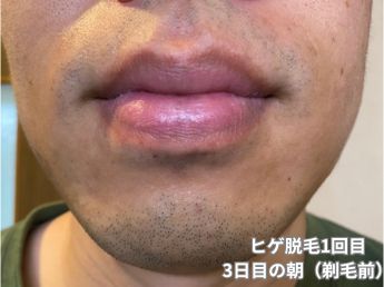 ヒゲ脱毛1回目の3日目の朝（鼻下・アゴ）