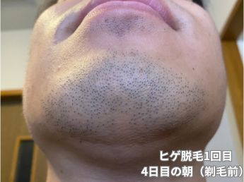 ヒゲ脱毛1回目の4日目の朝（アゴ下）