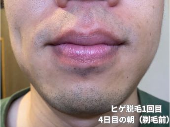 ヒゲ脱毛1回目の4日目の朝（鼻下・アゴ）