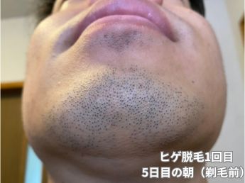 ヒゲ脱毛1回目の5日目の朝（アゴ下）
